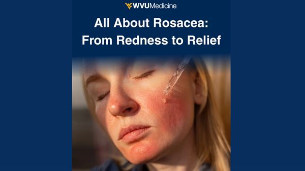 Rosacea: From Redness to Relief 