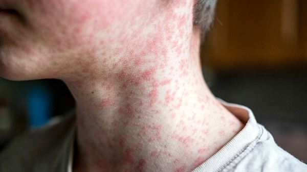 Measles FAQ