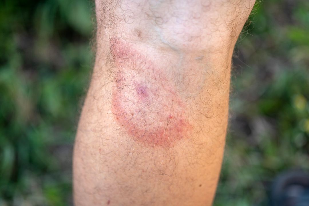 Tick Bite Rash.jpg