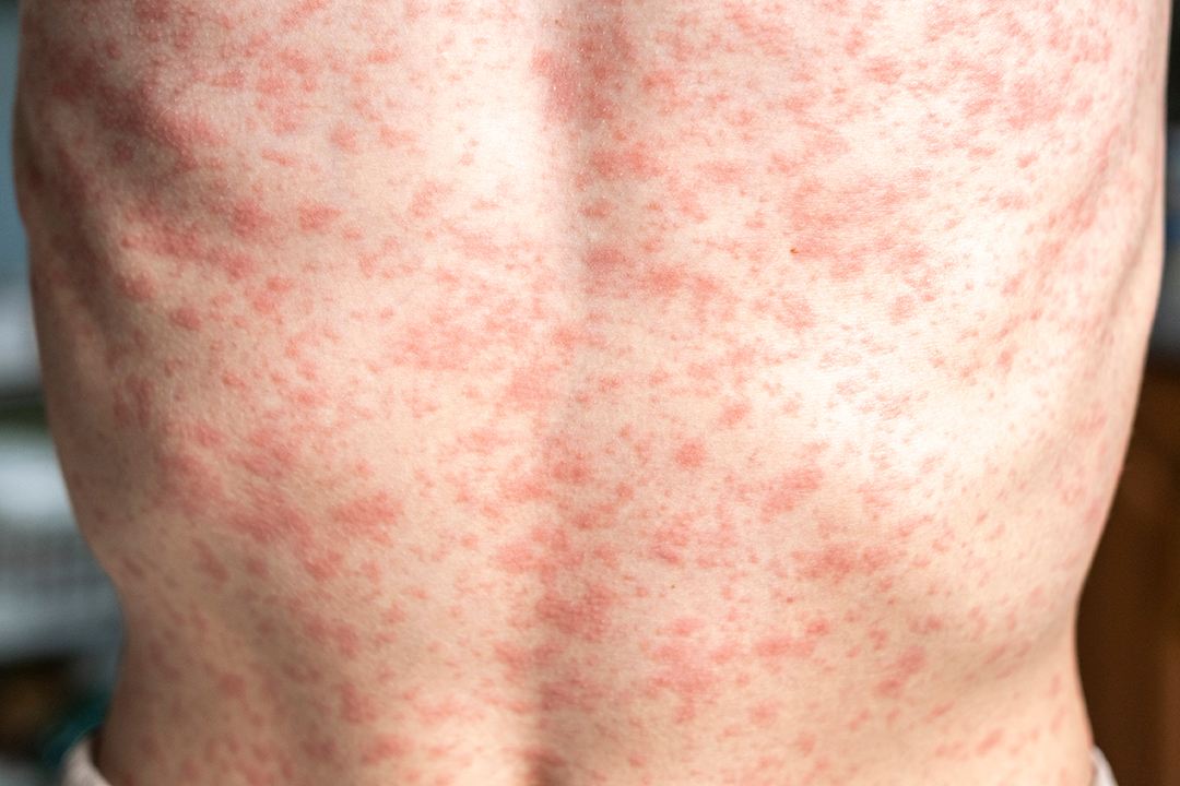 Measles pic 3.jpg