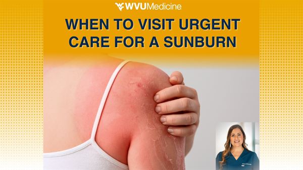 When to Visit Urgent Care for Sunburn 