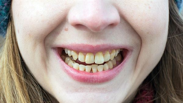 Ending embarrassment: Discolored teeth