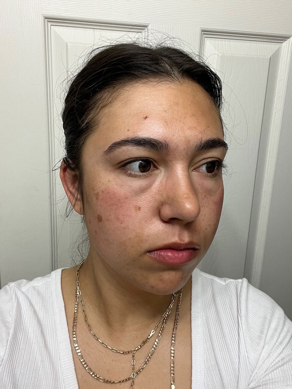 young-woman-with-swollen-face