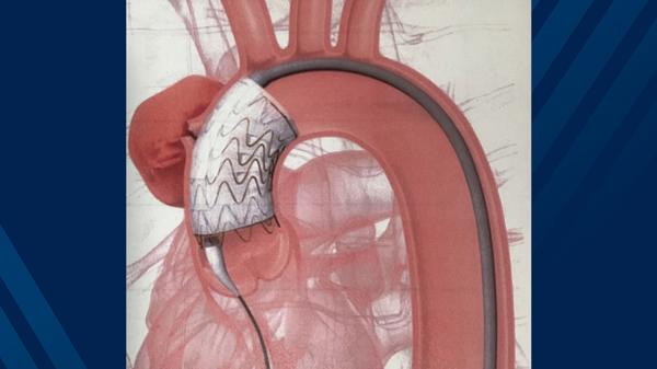 WVU Heart and Vascular Institute first in state and region to implant a novel aortic stent graft