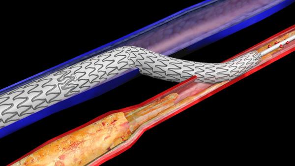 WVU Heart and Vascular Institute offers new treatment to save limbs and heal foot ulcers 