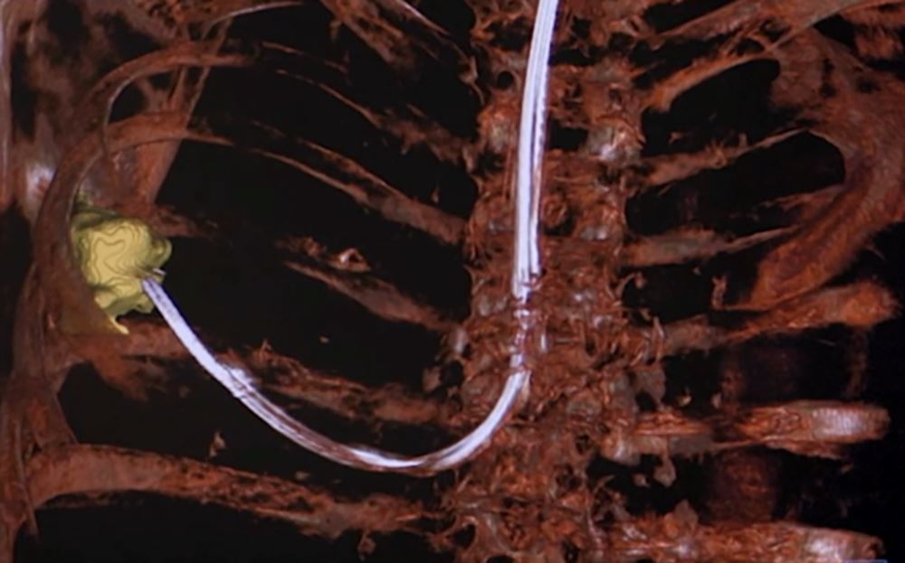 imaging-of c-t-scan-showing-lung-biopsy